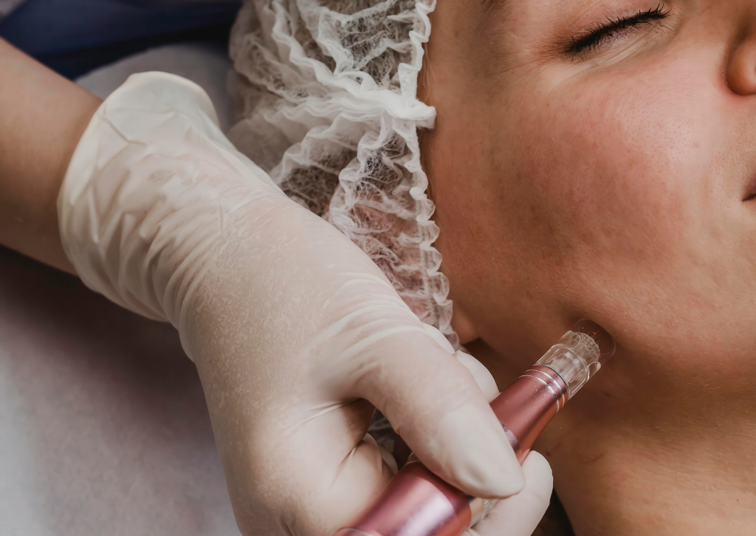 5 perguntas e respostas sobre microagulhamento