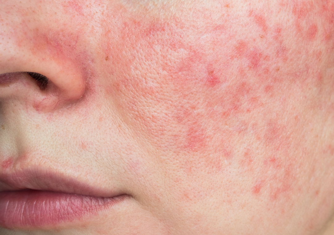 Rosácea: 3 sugestões de tratamento