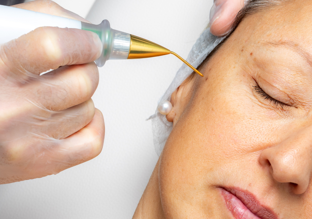 Jato de plasma no rejuvenescimento